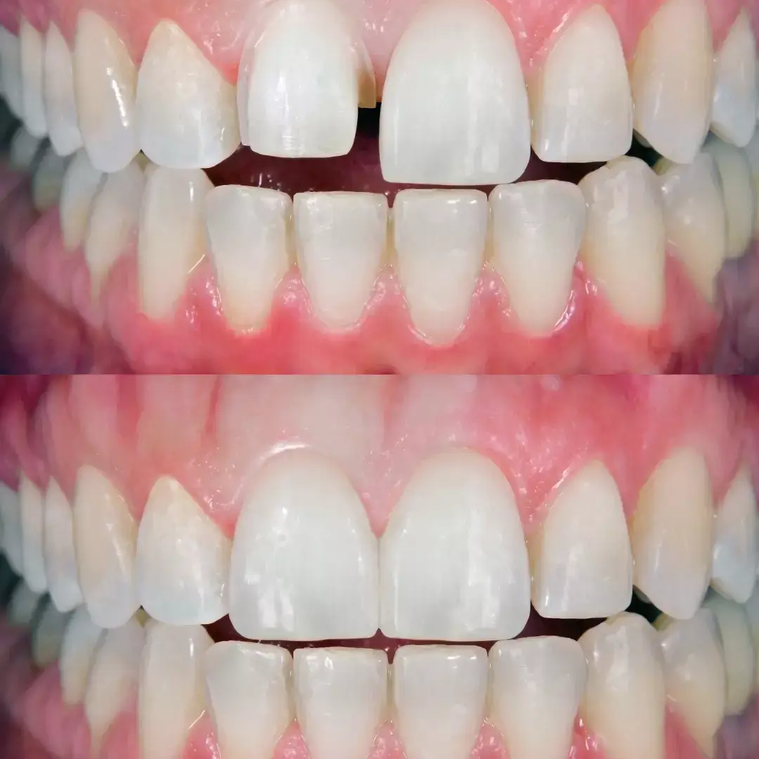 Veneers-in-Istanbul.webp